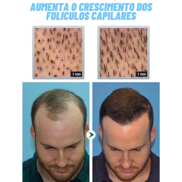 Hair Revive - Revolução do Transplante capilar