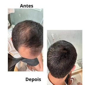 Hair Revive - Revolução do Transplante capilar